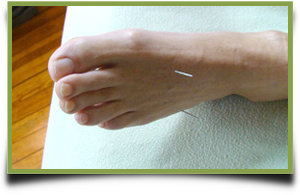 Tricia Miller Acupuncture Foot